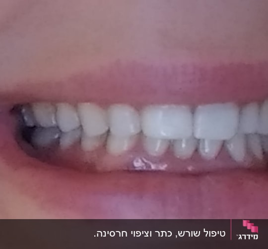 חיוך עם שיניים לבנות ובריאות